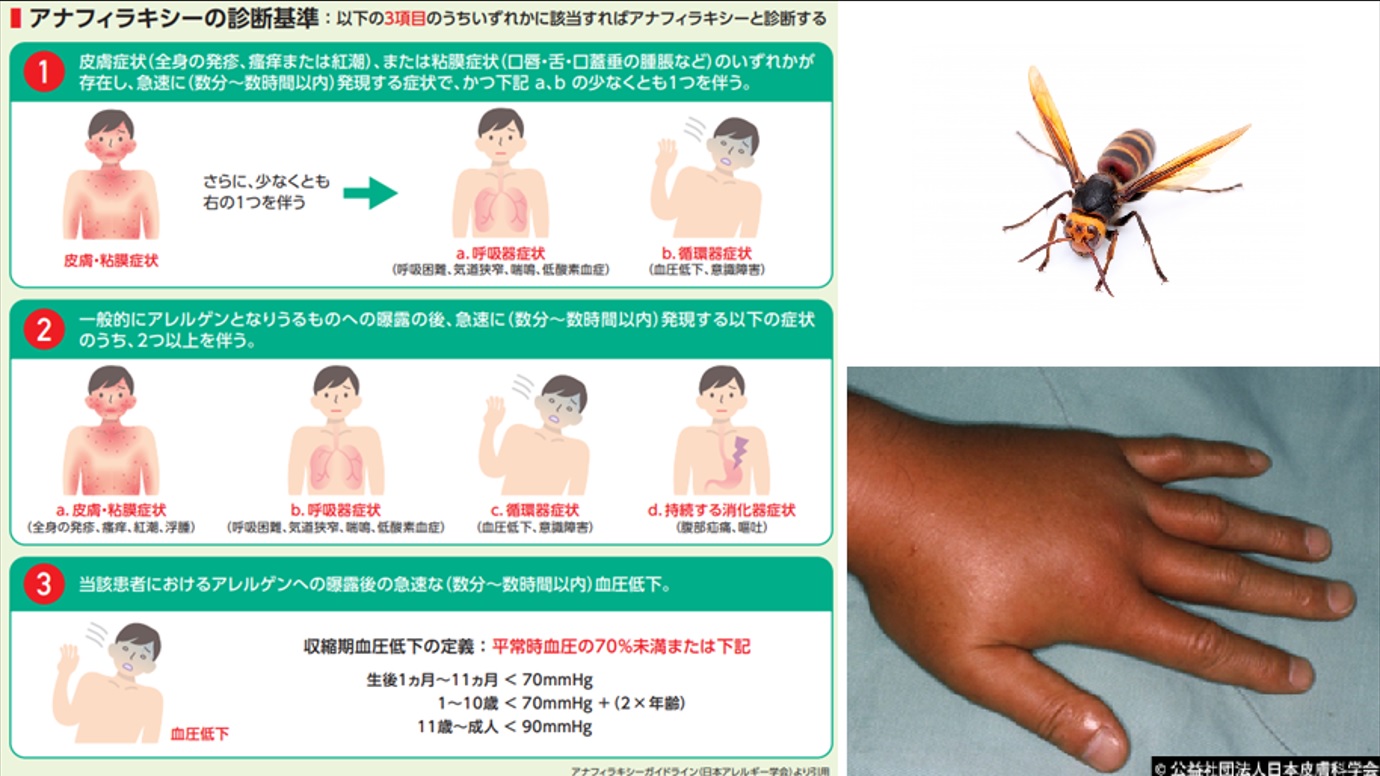 「虫刺され」「蜂さされ」の患者さんが増えています。